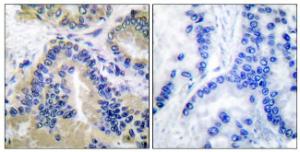 Immunohistochemical analysis of paraffin-embedded human lung carcinoma tissue using Anti-Caspase 10 Antibody. The right hand panel represents a negative control, where the antibody was pre-incubated with the immunising peptide