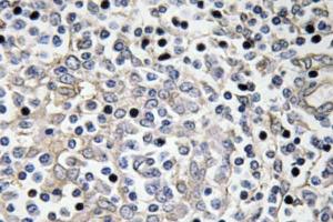 Immunohistochemical analysis of paraffin-embedded human lung carcinoma tissue using Anti-IL-16 Antibody