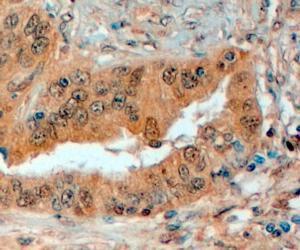 Anti-SEMA3E Antibody (A83324) (4µg/ml) staining of paraffin embedded Human Prostate. Steamed antigen retrieval with citrate buffer pH 6, HRP-staining.