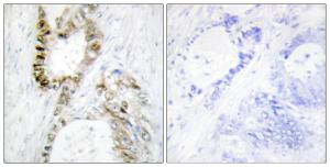 Immunohistochemical analysis of paraffin-embedded human colon carcinoma using Anti-FANCA Antibody. The right hand panel represents a negative control, where the antibody was pre-incubated with the immunising peptide