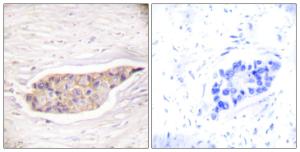 Immunohistochemical analysis of paraffin-embedded human breast carcinoma tissue using Anti-Annexin A6 Antibody The right hand panel represents a negative control, where the antibody was pre-incubated with the immunising peptide