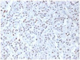 Immunohistochemical analysis of formalin-fixed, paraffin-embedded human mesothelioma using Anti-Wilms tumor Protein Antibody