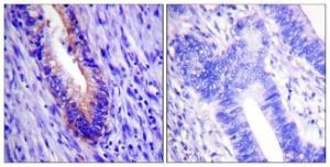 Immunohistochemical analysis of paraffin-embedded human colon carcinoma tissue using Anti-eIF4G Antibody. The right hand panel represents a negative control, where the Antibody was pre-incubated with the immunising peptide