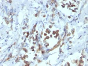 Immunohistochemical analysis of formalin-fixed, paraffin-embedded human gastric carcinoma using Anti-PAX6 Antibody [PAX6/1166]