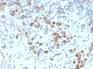 Immunohistochemical analysis of formalin-fixed, paraffin-embedded human gastric carcinoma using Anti-PAX6 Antibody [SPM612]