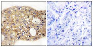 Immunohistochemical analysis of paraffin-embedded human breast carcinoma tissue using Anti-AGR3 Antibody. The right hand panel represents a negative control, where the Antibody was pre-incubated with the immunising peptide