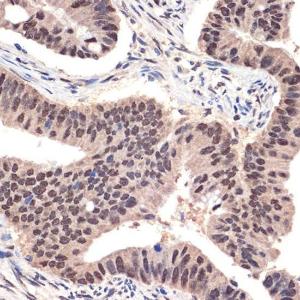 Immunohistochemistry analysis of paraffin-embedded human colon carcinoma tissue using Anti-EHMT2/G9A Antibody [ARC2470] (A305253) at a dilution of 1:100 (40X lens). Perform microwave antigen retrieval with 10 mM Tris/EDTA buffer pH 9.0 before commencing with IHC staining protocol