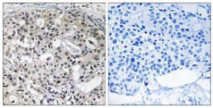 Immunohistochemical analysis of paraffin-embedded human breast carcinoma using Anti-CNTD2 Antibody. The right hand panel represents a negative control, where the antibody was pre-incubated with the immunising peptide