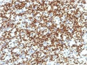 Immunohistochemical analysis of formalin-fixed, paraffin-embedded human rhabdomyosarcoma using Anti-PAX7 Antibody [PAX7/1187]