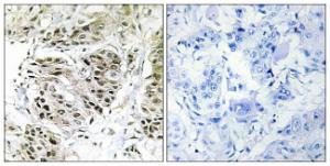 Immunohistochemical analysis of paraffin-embedded human breast carcinoma using Anti-CENPA Antibody. The right hand panel represents a negative control, where the antibody was pre-incubated with the immunising peptide.