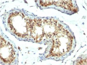 Immunohistochemical analysis of formalin-fixed, paraffin-embedded human testicular carcinoma using Anti-PAX7 Antibody [PAX7/1187]