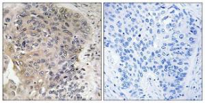 Immunohistochemical analysis of paraffin-embedded human lung carcinoma using Anti-CBCP3 Antibody. The right hand panel represents a negative control, where the Antibody was pre-incubated with the immunising peptide