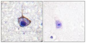 Immunohistochemical analysis of paraffin-embedded human breast cancer using Anti-Trk A (phospho Tyr791) Antibody 1:100 (4°C overnight). The right hand panel represents a negative control, where the antibody was pre-incubated with the immunising peptide