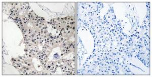 Immunohistochemical analysis of paraffin-embedded human breast carcinoma using Anti-BAGE4 Antibody The right hand panel represents a negative control, where the antibody was pre-incubated with the immunising peptide