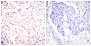 Immunohistochemical analysis of paraffin-embedded human breast carcinoma tissue using Anti-Fos Antibody The right hand panel represents a negative control, where the antibody was pre-incubated with the immunising peptide