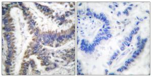 Immunohistochemical analysis of paraffin-embedded human lung carcinoma using Anti-DFF45 (cleaved Asp224) Antibody. The right hand panel represents a negative control, where the antibody was pre-incubated with the immunising peptide