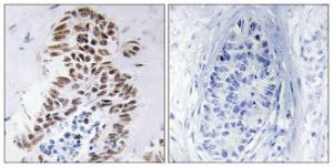 Immunohistochemical analysis of paraffin-embedded human lung carcinoma tissue using Anti-DAPK3 Antibody. The right hand panel represents a negative control, where the antibody was pre-incubated with the immunising peptide