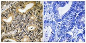 Immunohistochemical analysis of paraffin-embedded human colon carcinoma using Anti-4E-BP1 (phospho Thr70) Antibody. The right hand panel represents a negative control, where the antibody was pre-incubated with the immunising peptide