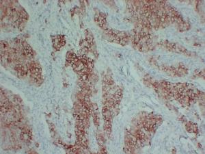 Immunohistochemical analysis of paraffin-embedded human Breast carcinoma using Anti-pS2 Antibody