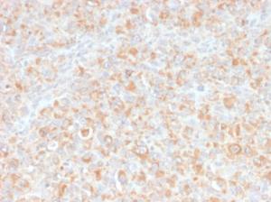 Immunohistochemical analysis of formalin-fixed, paraffin-embedded human histiocytoma using Anti-TNF alpha Antibody [SPM543]