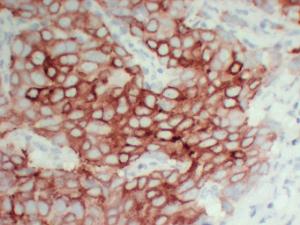 Immunohistochemical analysis of paraffin-embedded human Breast carcinoma-high magnification using Anti-pS2 Antibody