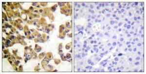 Immunohistochemical analysis of paraffin-embedded human breast cancer using Anti-BAD Antibody 1:100 (4°C overnight). The right hand panel represents a negative control, where the antibody was pre-incubated with the immunising peptide