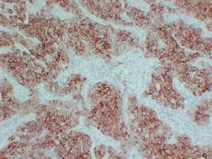 Immunohistochemical analysis of paraffin-embedded human Breast carcinoma using Anti-pS2 Antibody