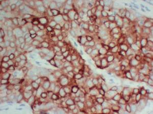 Immunohistochemical analysis of paraffin-embedded human Breast carcinoma-high magnification using Anti-pS2 Antibody