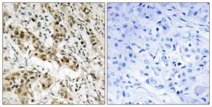 Immunohistochemical analysis of paraffin-embedded human breast carcinoma tissue using Anti-CtBP1 Antibody. The right hand panel represents a negative control, where the antibody was pre-incubated with the immunising peptide