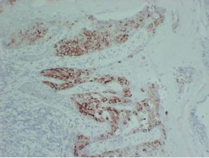 Immunohistochemical analysis of paraffin-embedded human Paget's disease of the breast using Anti-pS2 Antibody