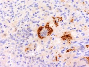 Immunohistochemical analysis of formalin-fixed, paraffin-embedded human Erdheim-Chester disease, also known as polyostotic sclerosing histiocytosis, using Anti-TNF alpha Antibody [P/T2]