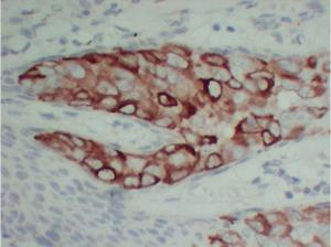 Immunohistochemical analysis of paraffin-embedded human Paget's disease of the breast-high magnification using Anti-pS2 Antibody