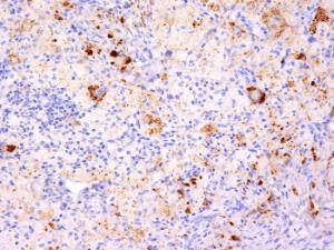 Immunohistochemical analysis of formalin-fixed, paraffin-embedded human Erdheim-Chester disease, also known as polyostotic sclerosing histiocytosis, using Anti-TNF alpha Antibody [TNF706 + P/T2]