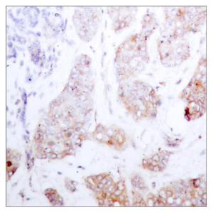 Immunohistochemical analysis of paraffin-embedded human breast carcinoma tissue using Anti-C-RAF Antibody The right hand panel represents a negative control, where the antibody was pre-incubated with the immunising peptide