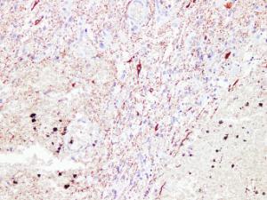 Immunohistochemical analysis of paraffin-embedded human Glioma using Anti-Neurofilament Antibody