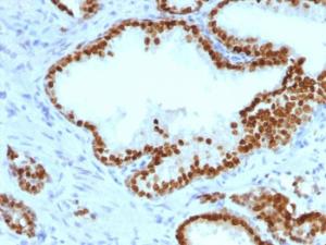 Immunohistochemical analysis of formalin-fixed, paraffin-embedded human prostate carcinoma using Anti-FOXA1 Antibody [FOXA1/1241]