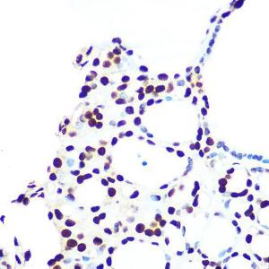 Immunohistochemistry analysis of paraffin-embedded human thyroid cancer using Anti-hnRNP U/p120 Antibody [ARC0942] (A307864) at a dilution of 1:100 (40X lens). Perform microwave antigen retrieval with 10 mM PBS buffer pH 7.2 before commencing with IHC staining protocol