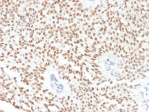 Immunohistochemical analysis of formalin-fixed, paraffin-embedded human bladder carcinoma using Anti-FOXA1 Antibody [FOXA1/1241]