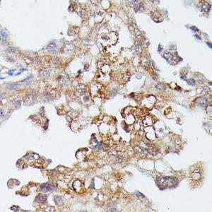 Immunohistochemistry analysis of paraffin-embedded human lung cancer using Anti-MAP3K4 Antibody (A93094) at a dilution of 1:100 (40x lens)