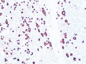 Immunohistochemical analysis of paraffin-embedded human Pituitary adenoma using Anti-Adrenocorticotropin Antibody