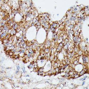 Immunohistochemistry analysis of paraffin-embedded human colon carcinoma tissue using Anti-MAP3K4 Antibody (A93094) at a dilution of 1:100 (40x lens)