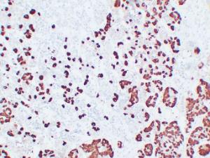 Immunohistochemical analysis of paraffin-embedded human Pituitary adenoma using Anti-Adrenocorticotropin Antibody