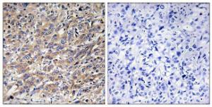 Immunohistochemical analysis of paraffin-embedded human liver carcinoma tissue using Anti-COX17 Antibody. The right hand panel represents a negative control, where the antibody was pre-incubated with the immunising peptide.