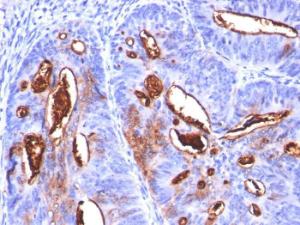 Immunohistochemical analysis of formalin-fixed, paraffin-embedded human colon carcinoma using Anti-CA19-9 Antibody [SPM588]