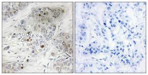 Immunohistochemical analysis of paraffin-embedded human breast carcinoma using Anti-p53 (phospho Ser9) Antibody. The right hand panel represents a negative control, where the Antibody was pre-incubated with the immunising peptide