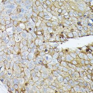 Immunohistochemistry analysis of paraffin-embedded human esophageal cancer using Anti-Syndecan-1 Antibody (A8893) at a dilution of 1:100 (40x lens). Perform high pressure antigen retrieval with 10 mM citrate buffer pH 6.0 before commencing with IHC staining protocol.