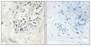 Immunohistochemical analysis of paraffin-embedded human breast cancer using Anti-ZNF23 Antibody 1:100 (4°C overnight). The right hand panel represents a negative control, where the antibody was pre-incubated with the immunising peptide.