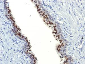 Immunohistochemical analysis of formalin-fixed, paraffin-embedded human prostate carcinoma using Anti-FOXA1 Antibody [FOXA1/1514]