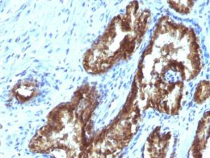 Immunohistochemical analysis of formalin-fixed, paraffin-embedded human prostate carcinoma using Anti-TDP2 Antibody [TDP2/1258]