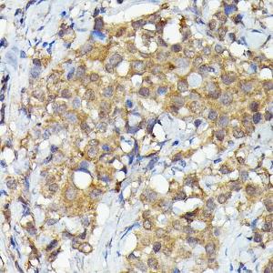 Immunohistochemistry analysis of paraffin-embedded human breast cancer tissue using Anti-MNK1 Antibody (A309108) at a dilution of 1:50 (40x lens). Perform high pressure antigen retrieval with 10 mM citrate buffer pH 6.0 before commencing with IHC staining protocol.